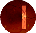 Slit image on fundus. Click for interactive simulation